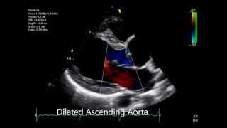 Bicuspid Aortic Valve [upl. by Elyr]