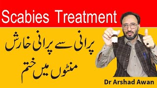 How To Treat Scabies In Urdu  Kharish Ka Fori ilaj [upl. by Zoara]