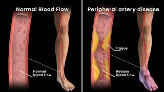 Peripheral Artery Disease Angioplasty [upl. by Schnabel754]