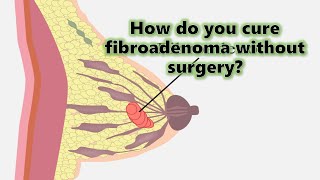 How do you cure fibroadenoma without surgeryfibroadenoma fibroadenoma treatment [upl. by Anoyet446]