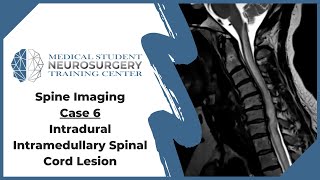 Spine Imaging Case 6 Intradural Intramedullary Spinal Cord Lesion [upl. by Nebur213]