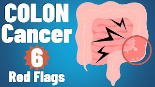 Colon cancer 6 EARLY symptoms amp why they occur  Colon cancer symptoms  colorectal cancer [upl. by Mahoney]