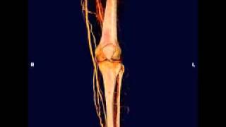 Venous Obstruction of the Thigh ThreeDimensional View of Venous Thrombosis [upl. by Negroj]