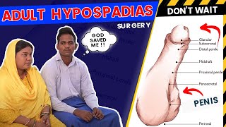 Hypospadias I Kolkata  वयस्क अधोमूत्रमार्गता  Hypospadias Surgery in India 🙂 Urethroplasty [upl. by Moulden870]