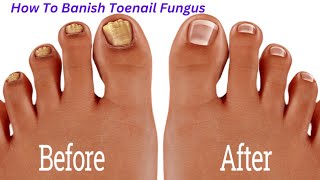 The Ultimate Guide To Banishing Toenail Fungus Rapidly And Naturally [upl. by Niddala]