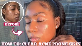 HOW I CLEARED MY ACNE SCARS amp HYPERPIGMENTATION FOR GOOD IN ONE MONTH  3 STEPS FOR FLAWLESS SKIN [upl. by Atinnek]