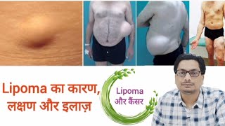 Lipoma  Lipoma Removal  Treatment of Lipoma  Lipoma cancer ke lakshan  Lipoma cancer ke lakshan [upl. by Arac]