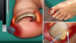 ASMR Ingrown toenail  Treatment corner of the toenail  Beautiful pedicure for girls [upl. by Rockwood799]