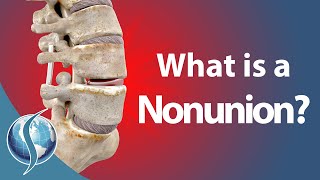 What is a Nonunion [upl. by Akirre]