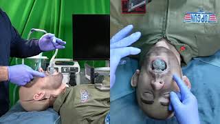 Introduction to the Suction Assisted iGel Insertion method and the use of the SEADUC [upl. by Eneloc887]