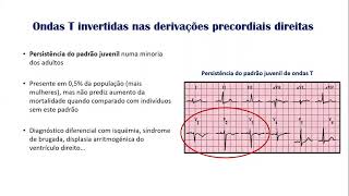 ECG  Alterações inespecificas da repolarização ventricular [upl. by Ecneralc]