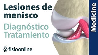 😩😩ROTURA DE MENISCO ► Diagnóstico y tratamiento de fisioterapia médico y quirúrgico [upl. by Blockus]