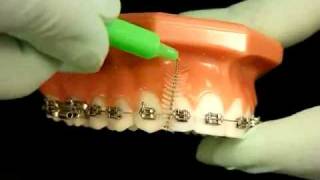 Bracesquestionscom  Brushing With Braces How to Brush Teeth [upl. by Micro]