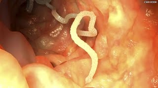 Mom feeds daughter tapeworm to lose weight [upl. by Frankhouse286]