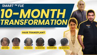 10Month Transformation with SMART™ FUE  HAIR TRANSPLANT MALAYSIA [upl. by Afrikah]