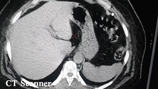 lithiase rénal TDM Abdominale sans injection [upl. by Rocray]