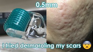 I tried dermarolling my ACNE SCARS  Demo  Review [upl. by Aseela434]