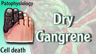 Dry Gangrene Necrosis شرح [upl. by Ahsinod]