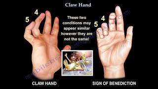 Claw Hand Ulnar Claw Hand  Everything You Need To Know  Dr Nabil Ebraheim [upl. by Kassey338]