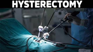 Think Twice before Getting a Hysterectomy [upl. by Latsirc]