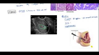 Endometrial Cancer and Hyperplasia for USMLE [upl. by Janka]