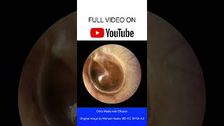 Otitis Media with Effusion Otoscopy [upl. by Vento]