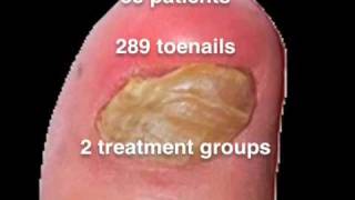 Nail Lacquer Shown Effective for Toenail Fungus [upl. by Anivid]