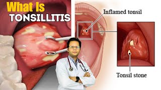 Tonsillitis  Causes Signs Treatment Symptoms In Hindi [upl. by Sixela]