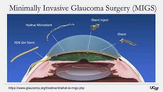 Understanding Glaucoma Diagnosis Treatment and Research on the Horizon [upl. by Halludba]