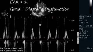 ANTEROSEPTAL AKINESISECHOCARDIOGRAPHY SERIES BY DR ANKUR K CHAUDHARI [upl. by Deeann]