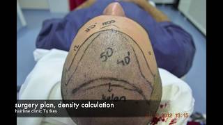 Hair Transplant Turkey REPAIR HAIR TRANSPLANT FUE 3340 GRAFTS [upl. by Edrei116]