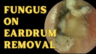 Aspergillus Niger Sits On Eardrum [upl. by Hametaf322]