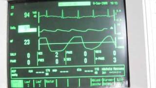 breath hold EKG with oxygen desaturation [upl. by Anekahs]