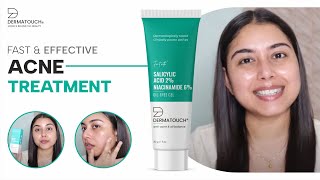 How to Treat Acne Prone Skin  Dermatouch Salicylic Acid amp Niacinamide Oil Free Gel [upl. by Allenaj297]