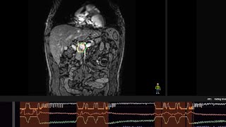 MRlinac Comprehensive Motion Mangement [upl. by Kcirddet]