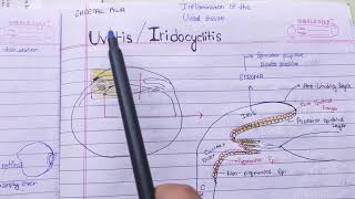 Uveitis Iridocyclitis theory examination notes AK khurana [upl. by Uriisa461]