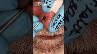 Nose Blackheads  Removal by DrLalit Kasana [upl. by Munsey]