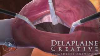 Robotic Atrial Septal Defect Repair [upl. by Jacquelyn956]