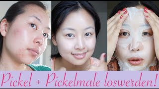 5 Tipps gegen Pickel  Pickelmale  so wirst du sie schnell los [upl. by Suisyola]