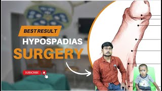 Hypospadias  मूत्र का छिद्र सही जगह पर न खुलने की समस्या  Hypospadias Repair in India  Dr Nagwani [upl. by Tawsha]