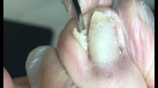 Thick and twisted nail treatment [upl. by Sabec]