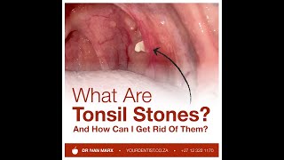 What are Tonsil Stones And how can I get rid of them [upl. by Kally]