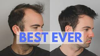 TOP 10 Hair Loss Treatments  Ranked by New Hair Growth [upl. by Soll]