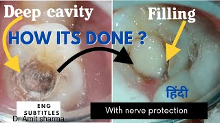 How Deep cavity filling done with nerve protection  pulp capping  Treatment of sensitive cavities [upl. by Geoff]