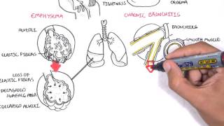 Chronic Obstructive Pulmonary Disease Overview types pathology treatment [upl. by Nannaihr]