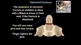 Odontoid Fractures  Everything You Need To Know  Dr Nabil Ebraheim [upl. by Yael]