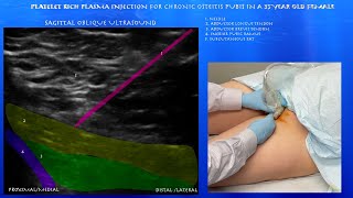 Ultrasound of Platelet Rich Plasma Injection for Osteitis Pubis in a 35 Year Old Female [upl. by Yldarb327]