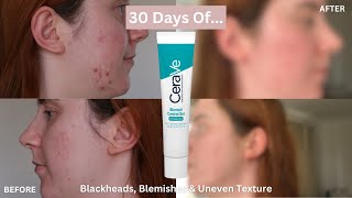 30 DAYS OF Cerave Blemish Control Gel for Blemishes Blackheads and Uneven Texture One Month Review [upl. by Weiser849]