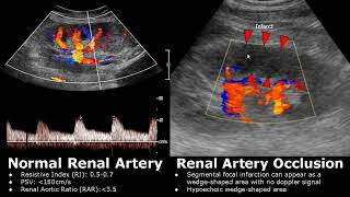 Renal Artery Doppler Ultrasound Normal Vs Abnormal Images  StenosisOcclusionAVM  Kidney USG [upl. by Jaella129]