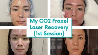 I FINALLY Got CO2 Fraxel Laser for my Atrophic Acne Scars Recovery Vlog  michxmash [upl. by Anali]